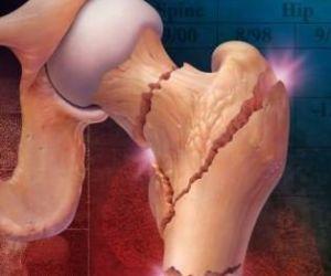 Израильские ученые разработали новый принцип лечения остеопороза