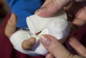 Израильские врачи спасли палец двухлетнему ребенку
